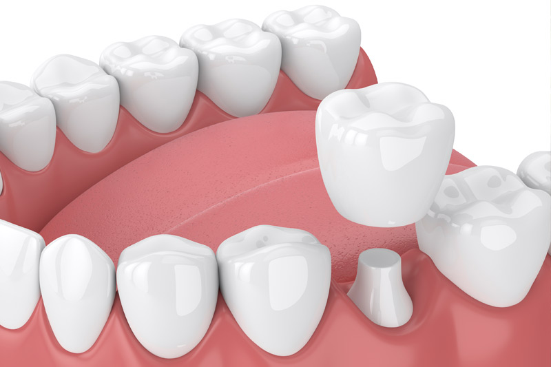 Dental Crowns in San Bernardino