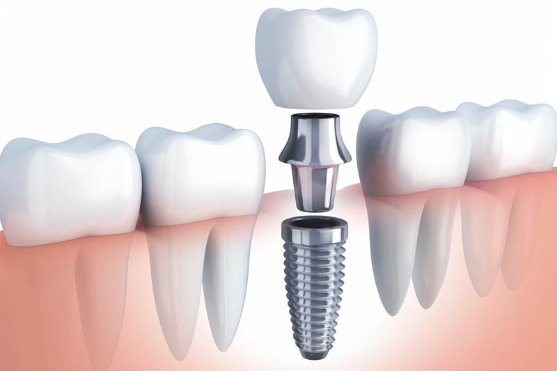 Implants Dentist in San Bernardino