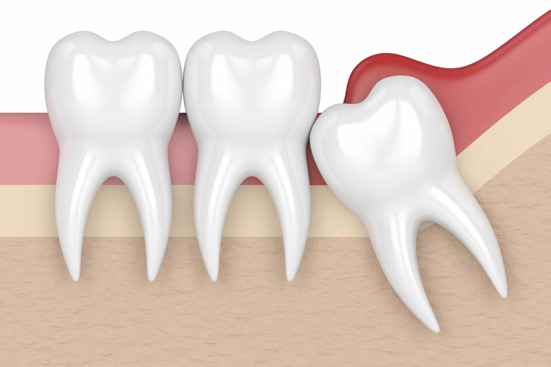 Wisdom Tooth Removal in San Bernardino